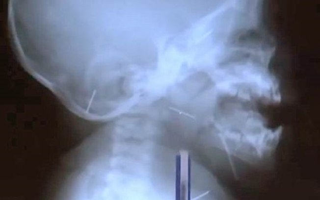 Raio X de bebê perfurado com agulhas em ritual para 'afastar espíritos malignos' na Ásia