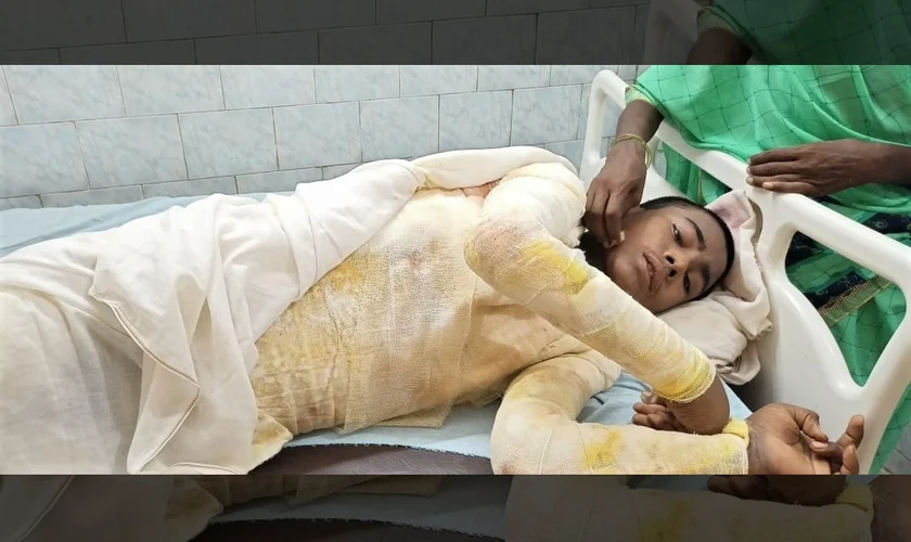 Ataque na Índia deixou Nitish Kumar, 16 anos, com queimaduras em 65% do corpo. (Foto: Morning Star News)