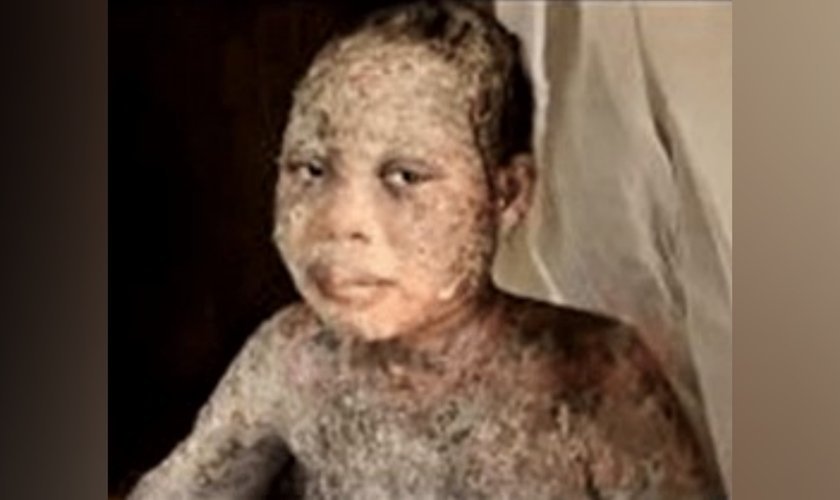 Amina Nagudi, de 13 anos, foi atacada com ácido junto com os pais, por aceitar Jesus, em Uganda. (Foto: Morning Star News).