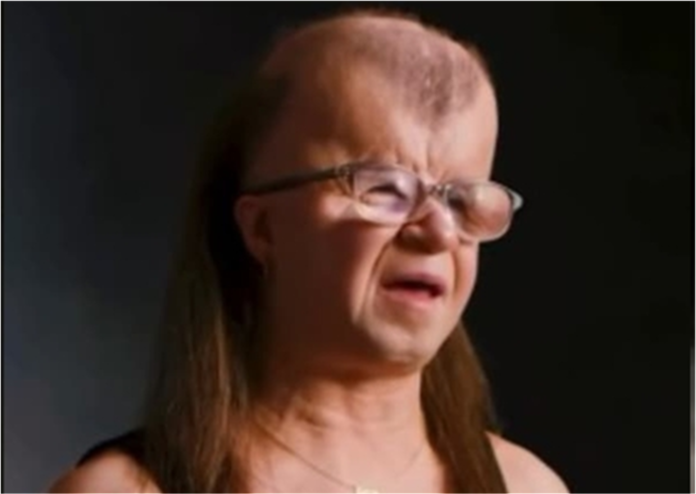 Mulher com síndrome rara sorri com fé e resiliência